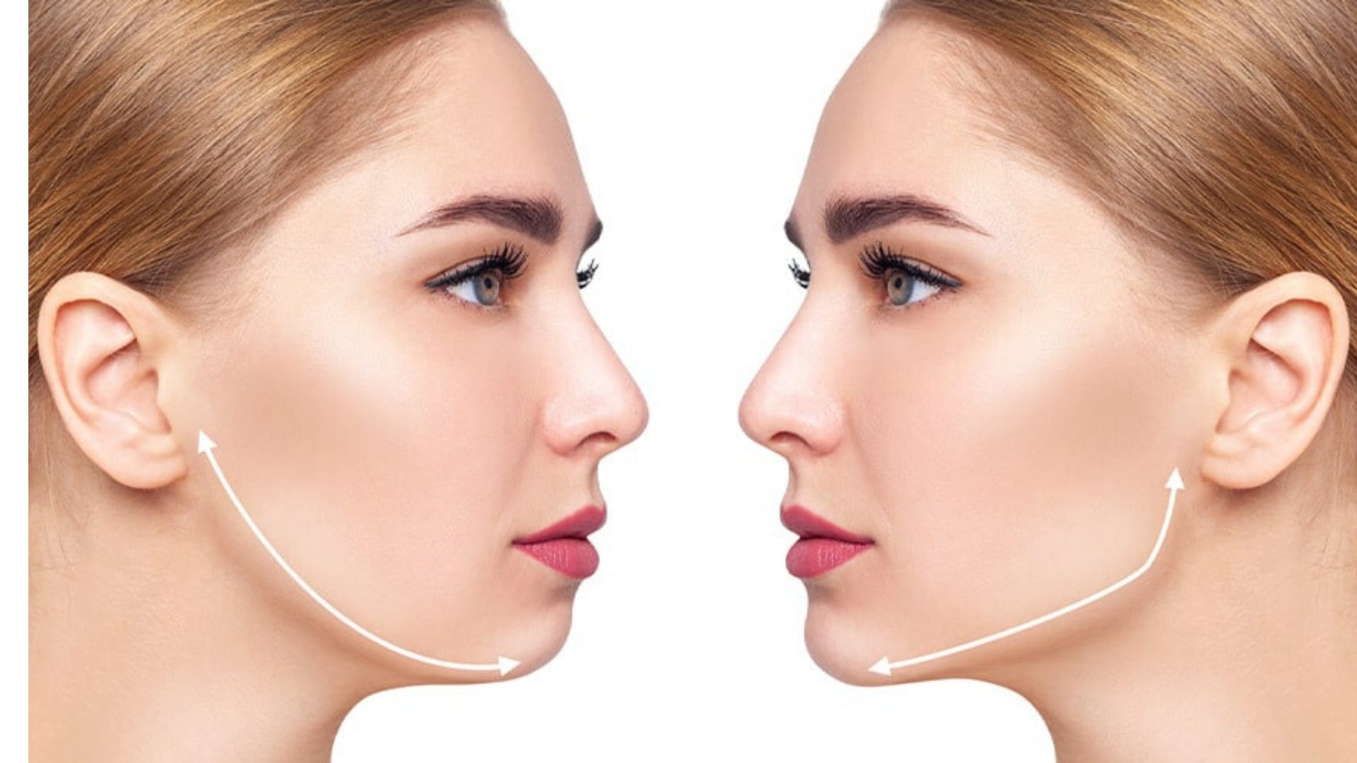 Jawline (Çene Hattı) Dolgu